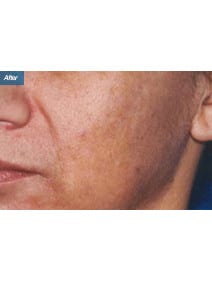 Microneedling