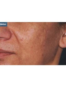 Microneedling