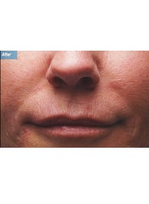 Nasolabial Folds