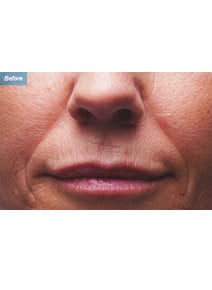 Nasolabial Folds