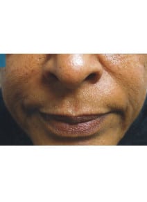 Nasolabial Folds