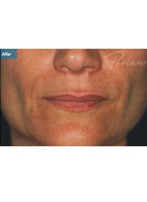 Nasolabial Folds