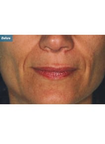 Nasolabial Folds