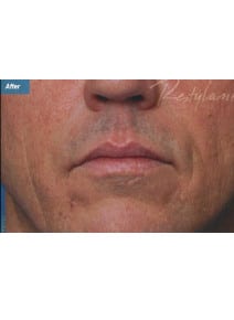 Nasolabial Folds