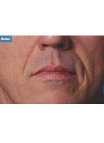 Nasolabial Folds