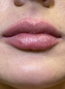 Lip Augmentation