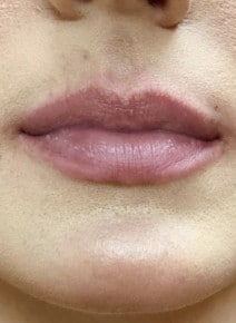 Lip Augmentation